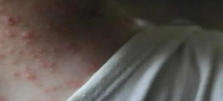 Reportan incremento en casos de viruela símica